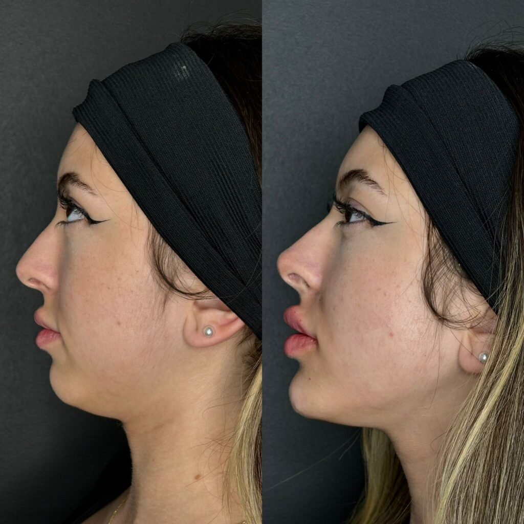 Perfiloplastia - Arabian Face