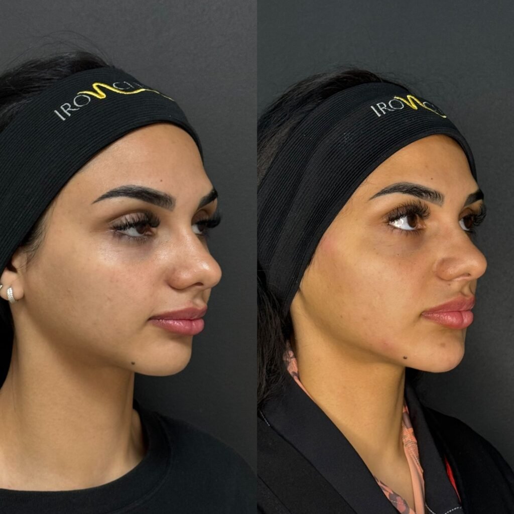 Perfiloplastia - Arabian face